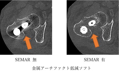 金属アーチファクト低減ソフト